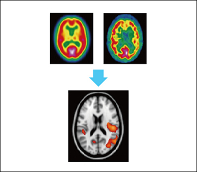 SPECT Processing and analysis of magnetic resonance images of brain nervous...