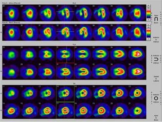 Application of radionuclide myocardial perfusion imaging and radionuclide perfusion imaging